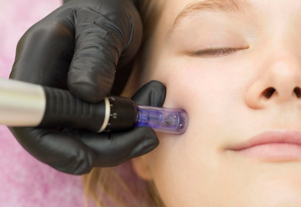 microneedling