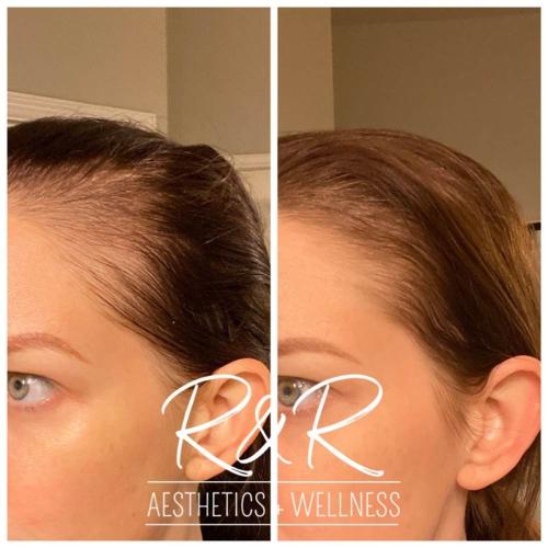 hair restoration before and after in fort worth texas