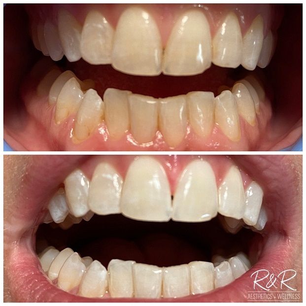 teeth whitening before and after